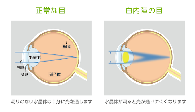 大阪日语翻译 白内障手术 中日医疗翻译